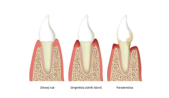 Cross-section of inflamed gums Periodontitis caused by inflammation of the gums